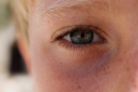 fényérzékenység szem hogyan lehet természetes módon csökkenteni az anti aging